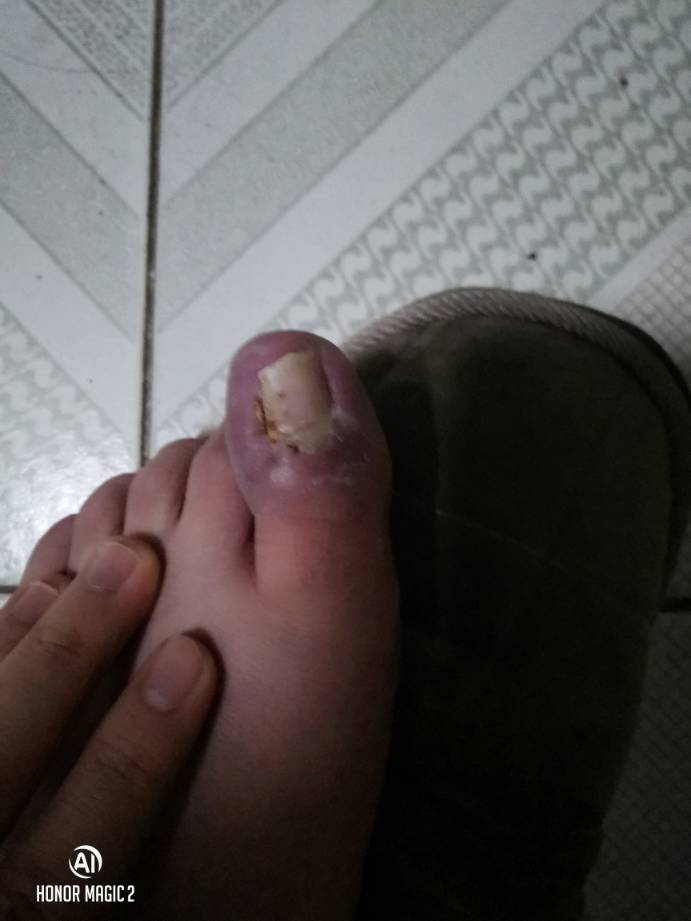 AG官网-灰熊JJJ正式接受脚趾手术三个月后重新评估的简单介绍